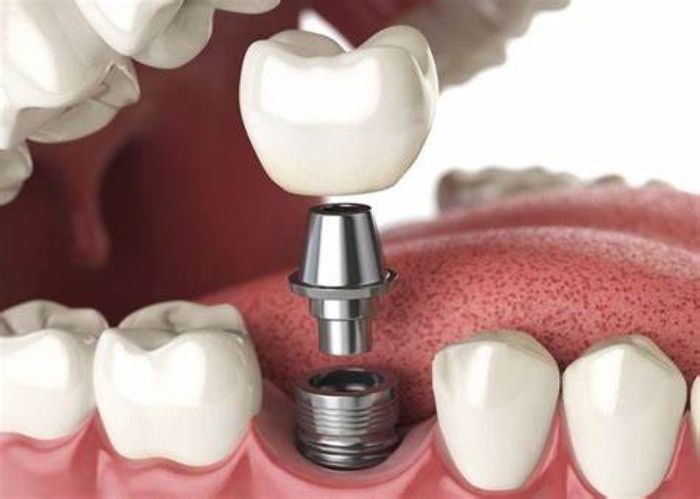Sau khi nhổ răng bao lâu thì trồng implant được? Giải đáp từ chuyên gia
