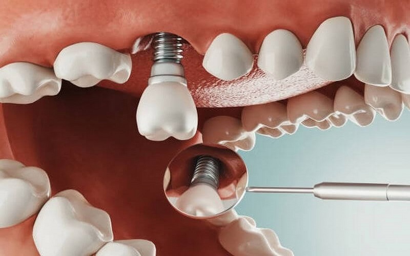 Chăm sóc răng sau khi cấy implant: Những lưu ý quan trọng giúp bạn phục hồi nhanh chóng