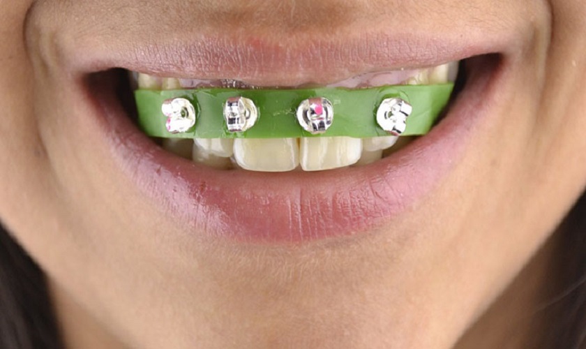 Niềng răng tại nhà: Hướng dẫn chi tiết và những điều cần biết